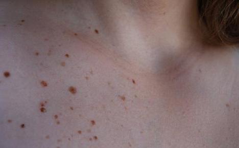 Aujourd’hui, y a contrôle… des grains de beauté !