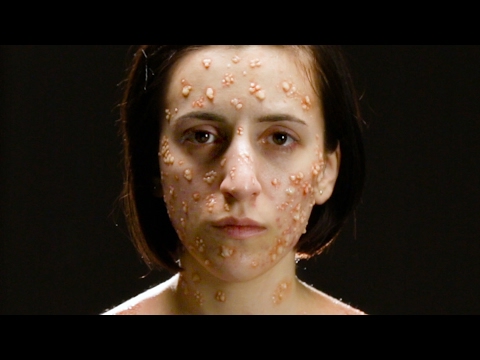 Ne pas vacciner : Le risque en vidéo 